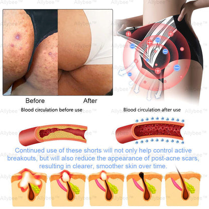 🥇Medical Grade Titanium Fiber Self-heating Tourmaline Shaping Shorts💌: Lymphedema, Varicose Veins, Scars and Stretch Marks, Gynecological Issues, Acne, Butt Sculpting