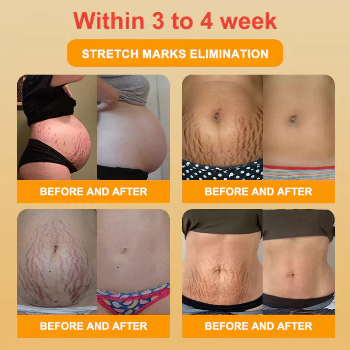 🥇Medical Grade Titanium Fiber Self-heating Tourmaline Shaping Shorts💌: Lymphedema, Varicose Veins, Scars and Stretch Marks, Gynecological Issues, Acne, Butt Sculpting