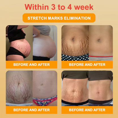 🥇Medical Grade Titanium Fiber Self-heating Tourmaline Shaping Shorts💌: Lymphedema, Varicose Veins, Scars and Stretch Marks, Gynecological Issues, Acne, Butt Sculpting