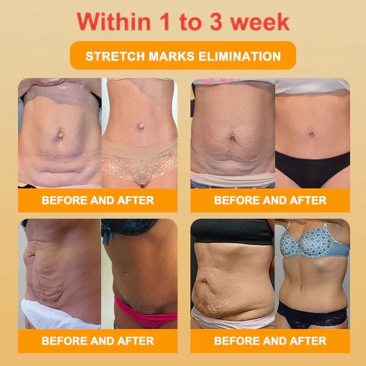 🥇Medical Grade Titanium Fiber Self-heating Tourmaline Shaping Shorts💌: Lymphedema, Varicose Veins, Scars and Stretch Marks, Gynecological Issues, Acne, Butt Sculpting