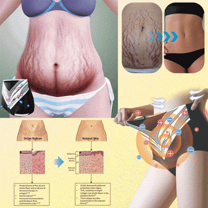 🥇Medical Grade Titanium Fiber Self-heating Tourmaline Shaping Shorts💌: Lymphedema, Varicose Veins, Scars and Stretch Marks, Gynecological Issues, Acne, Butt Sculpting